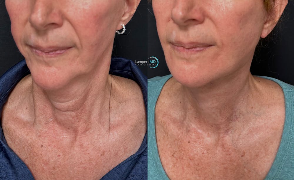 Face & Neck Lift Before & After Gallery - Patient 989129 - Image 3