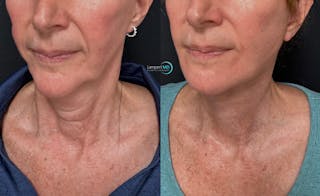Face & Neck Lift Before & After Gallery - Patient 989129 - Image 3