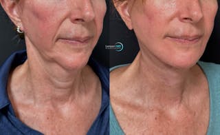 Face & Neck Lift Before & After Gallery - Patient 989129 - Image 2