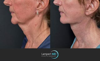 Face & Neck Lift Before & After Gallery - Patient 989129 - Image 4