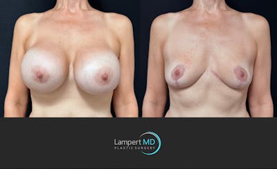 Breast Explant Before & After Gallery - Patient 318572 - Image 1