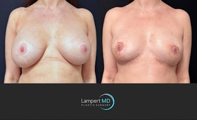 Breast Explant Before & After Gallery - Patient 370082 - Image 1