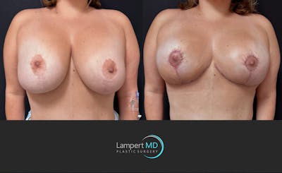 Breast Explant Before & After Gallery - Patient 222210 - Image 1