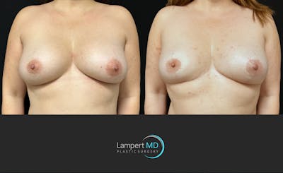 Breast Explant Before & After Gallery - Patient 127062 - Image 1