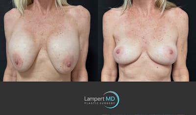 Breast Explant Before & After Gallery - Patient 262466 - Image 1