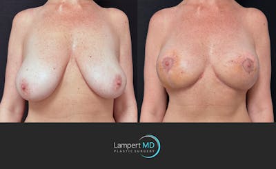 Breast Lift Before & After Gallery - Patient 870989 - Image 1