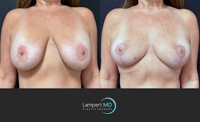 Breast Explant Before & After Gallery - Patient 907665 - Image 1