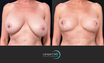 Breast Explant Before & After Gallery - Patient 299376 - Image 1
