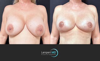Breast Explant Before & After Gallery - Patient 360529 - Image 1