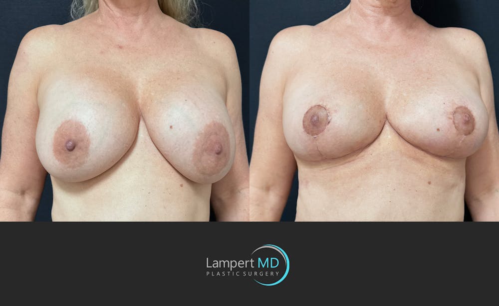 Breast Explant Before & After Gallery - Patient 360529 - Image 2