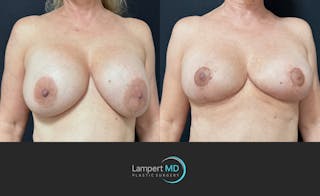 Breast Explant Before & After Gallery - Patient 360529 - Image 2