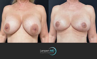 Breast Explant Before & After Gallery - Patient 360529 - Image 3