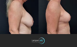 Breast Explant Before & After Gallery - Patient 360529 - Image 4