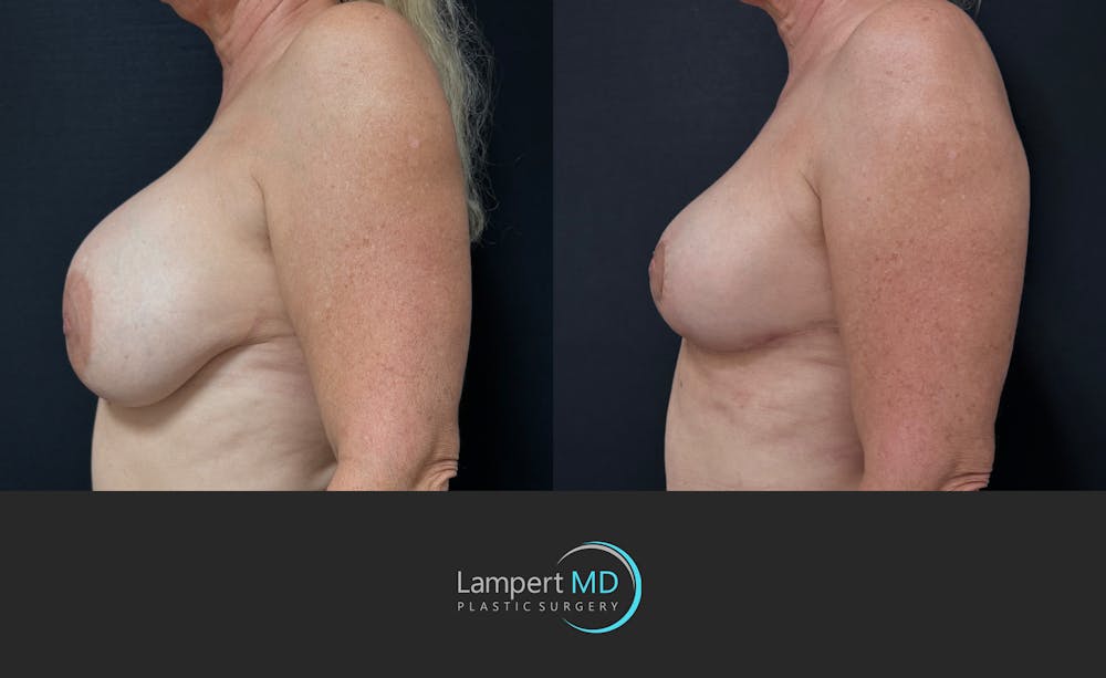Breast Explant Before & After Gallery - Patient 360529 - Image 5