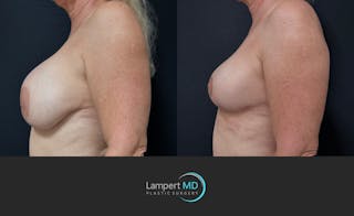 Breast Explant Before & After Gallery - Patient 360529 - Image 5