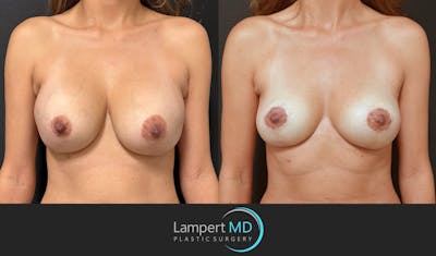 Breast Explant Before & After Gallery - Patient 356229 - Image 1