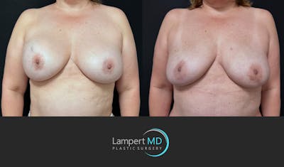 Breast Explant Before & After Gallery - Patient 173060 - Image 1