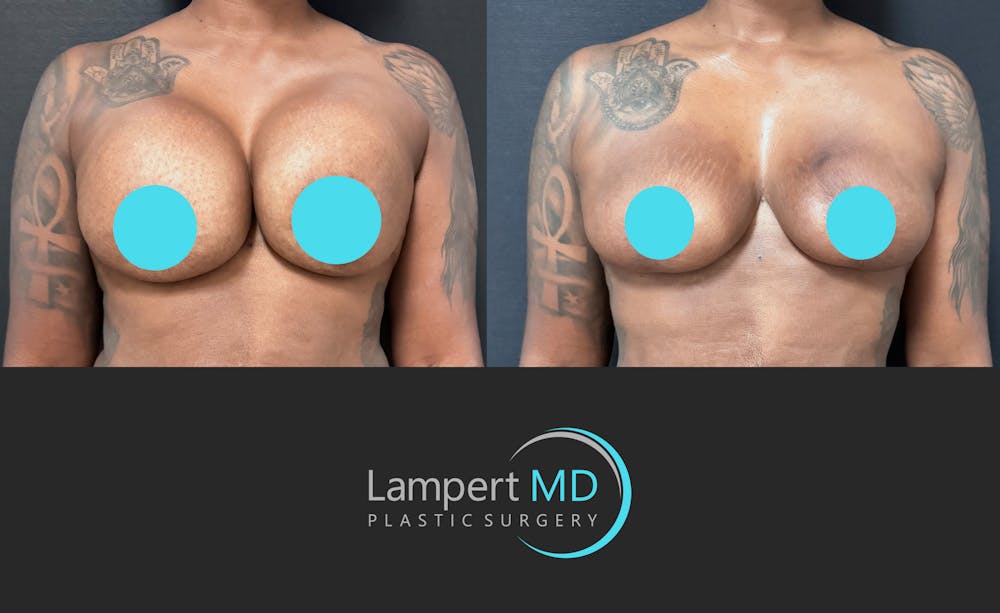 Breast Explant Before & After Gallery - Patient 268930 - Image 1