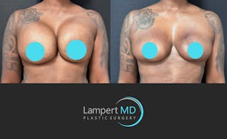 Breast Explant Before & After Gallery - Patient 268930 - Image 1
