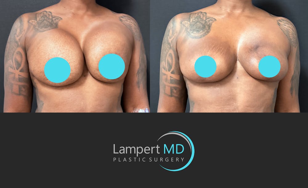 Breast Explant Before & After Gallery - Patient 268930 - Image 2