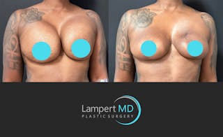 Breast Explant Before & After Gallery - Patient 268930 - Image 2