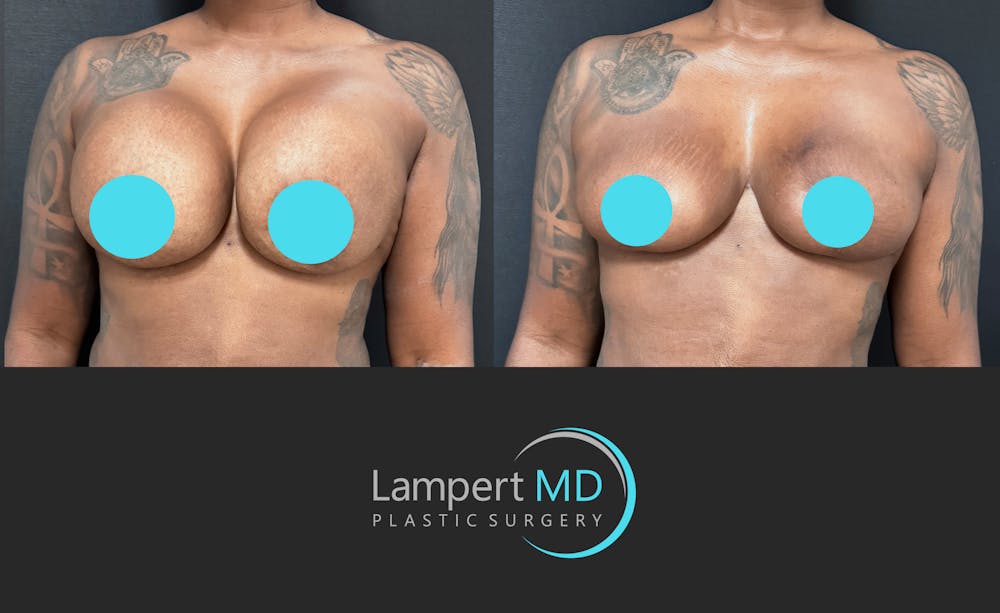 Breast Explant Before & After Gallery - Patient 268930 - Image 3