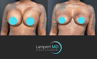 Breast Explant Before & After Gallery - Patient 268930 - Image 3
