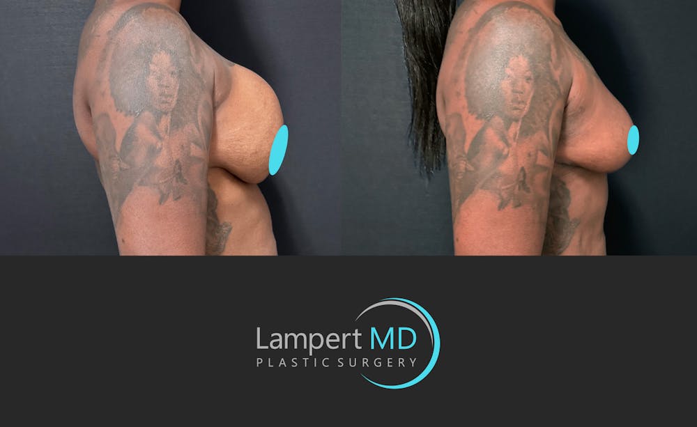 Breast Explant Before & After Gallery - Patient 268930 - Image 4