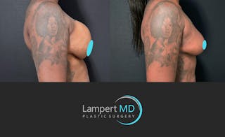 Breast Explant Before & After Gallery - Patient 268930 - Image 4