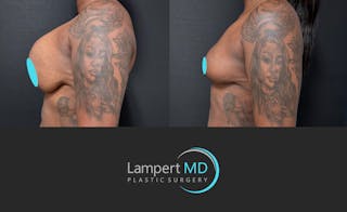 Breast Explant Before & After Gallery - Patient 268930 - Image 5