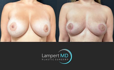 Breast Explant Before & After Gallery - Patient 400179 - Image 1