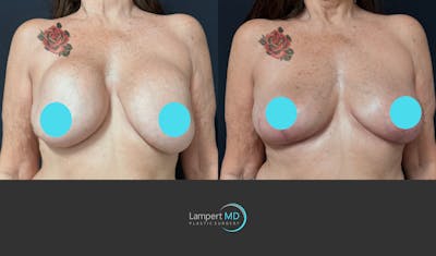 Breast Explant Before & After Gallery - Patient 179458 - Image 1