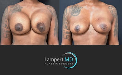 Breast Explant Before & After Gallery - Patient 138240 - Image 1