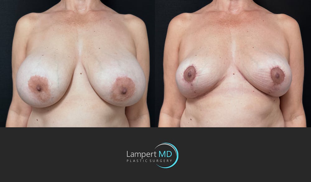 Breast Explant Before & After Gallery - Patient 401451 - Image 1