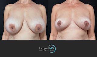 Breast Explant Before & After Gallery - Patient 401451 - Image 1