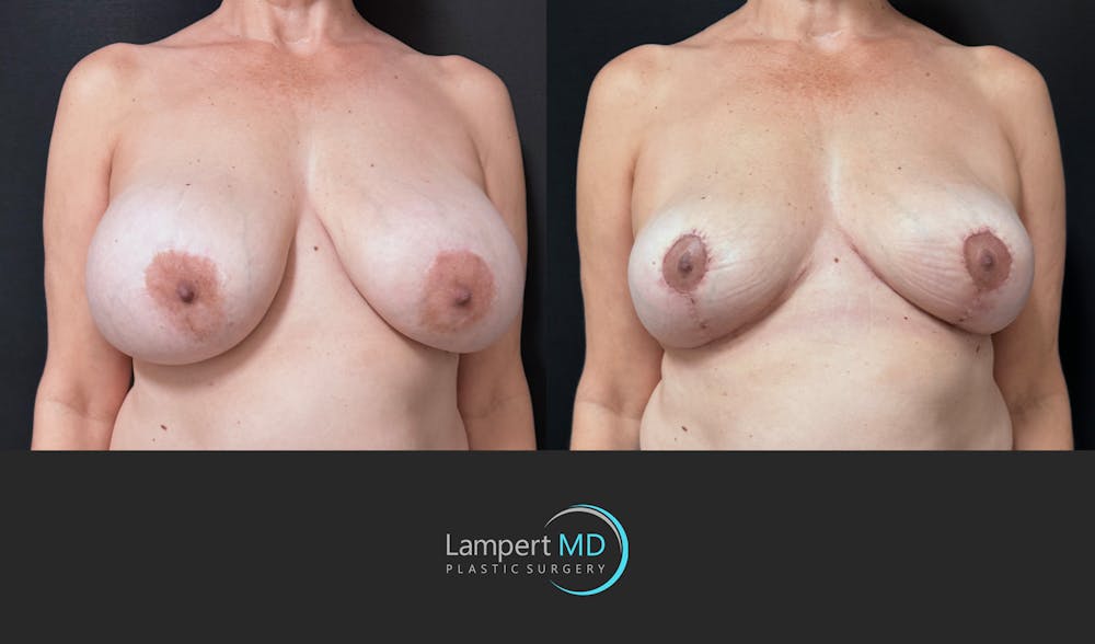 Breast Explant Before & After Gallery - Patient 401451 - Image 2