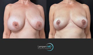 Breast Explant Before & After Gallery - Patient 401451 - Image 2