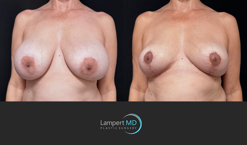 Breast Explant Before & After Gallery - Patient 401451 - Image 3