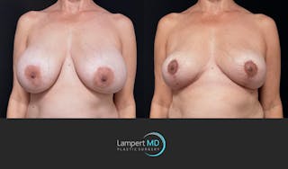 Breast Explant Before & After Gallery - Patient 401451 - Image 3