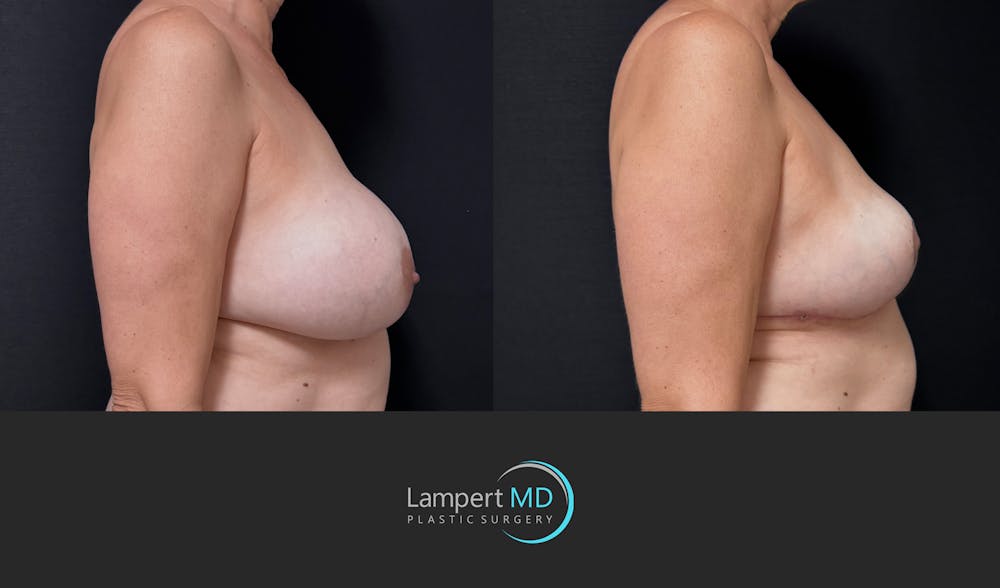 Breast Explant Before & After Gallery - Patient 401451 - Image 4