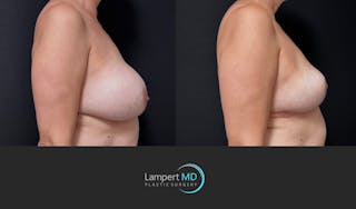 Breast Explant Before & After Gallery - Patient 401451 - Image 4