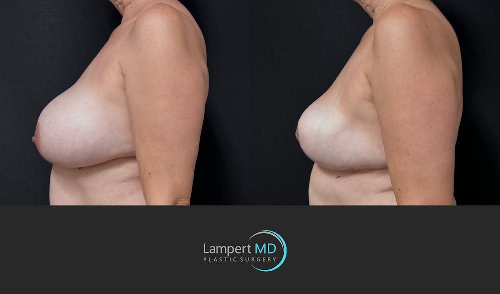 Breast Explant Before & After Gallery - Patient 401451 - Image 5