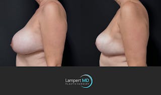 Breast Explant Before & After Gallery - Patient 401451 - Image 5