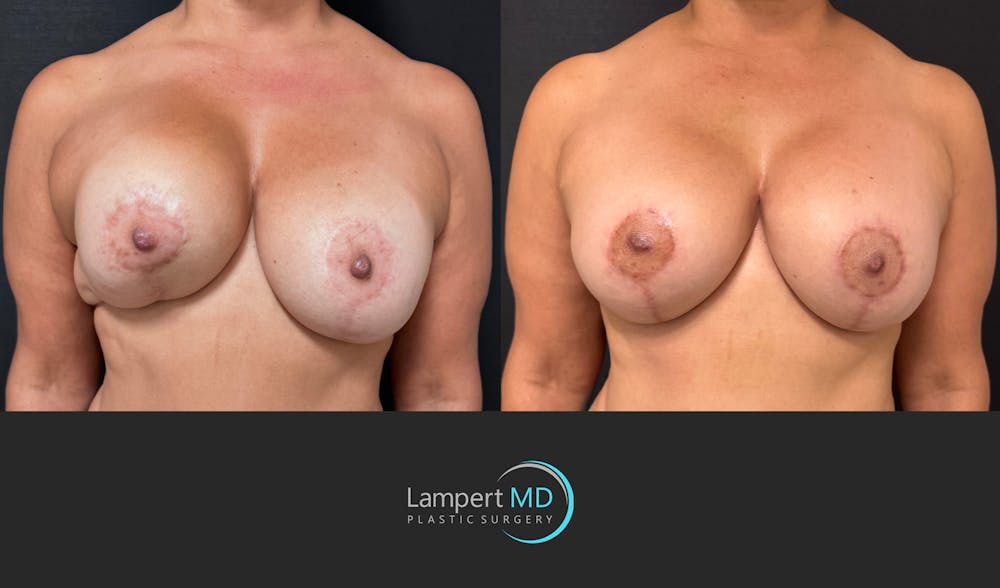 Breast Revision Before & After Gallery - Patient 399570 - Image 1