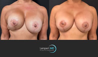 Breast Revision Before & After Gallery - Patient 399570 - Image 1