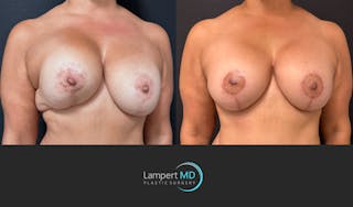 Breast Revision Before & After Gallery - Patient 399570 - Image 2