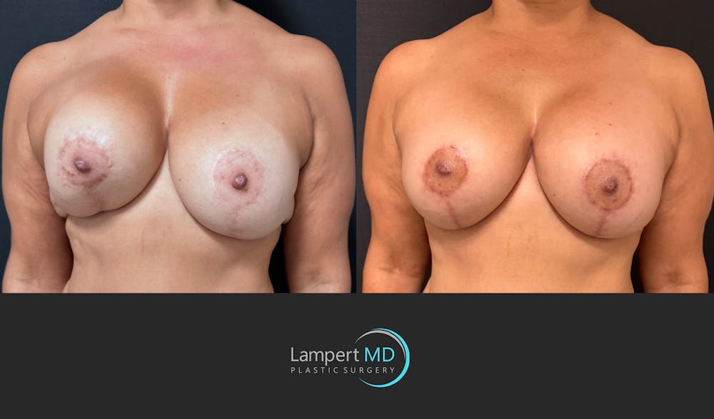 Breast Revision Before & After Gallery - Patient 399570 - Image 3