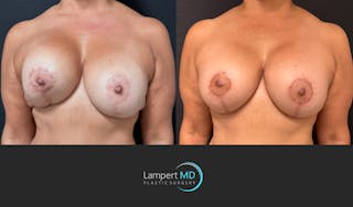 Breast Revision Before & After Gallery - Patient 399570 - Image 3