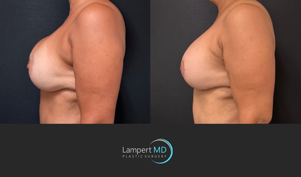 Breast Revision Before & After Gallery - Patient 399570 - Image 5