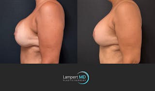 Breast Revision Before & After Gallery - Patient 399570 - Image 5